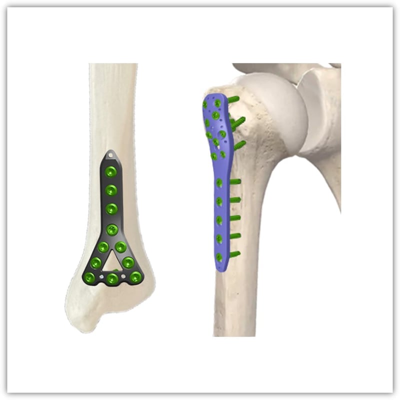 Locking Plate System with Cortical Screws